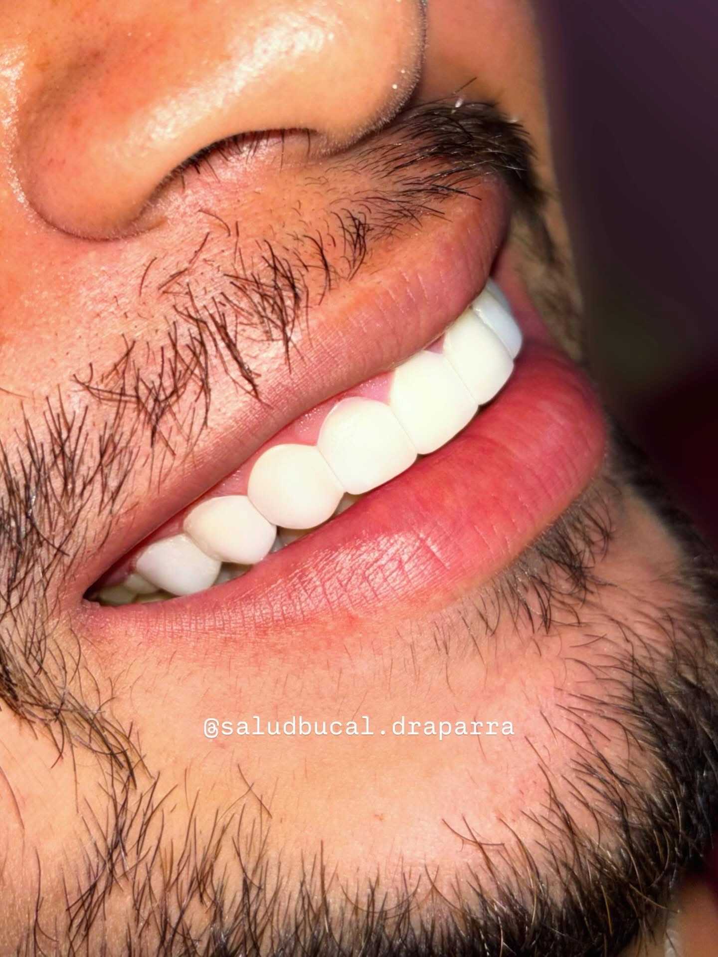 Resultado de blanqueamiento dental: sonrisa con tono blanco uniforme y natural
