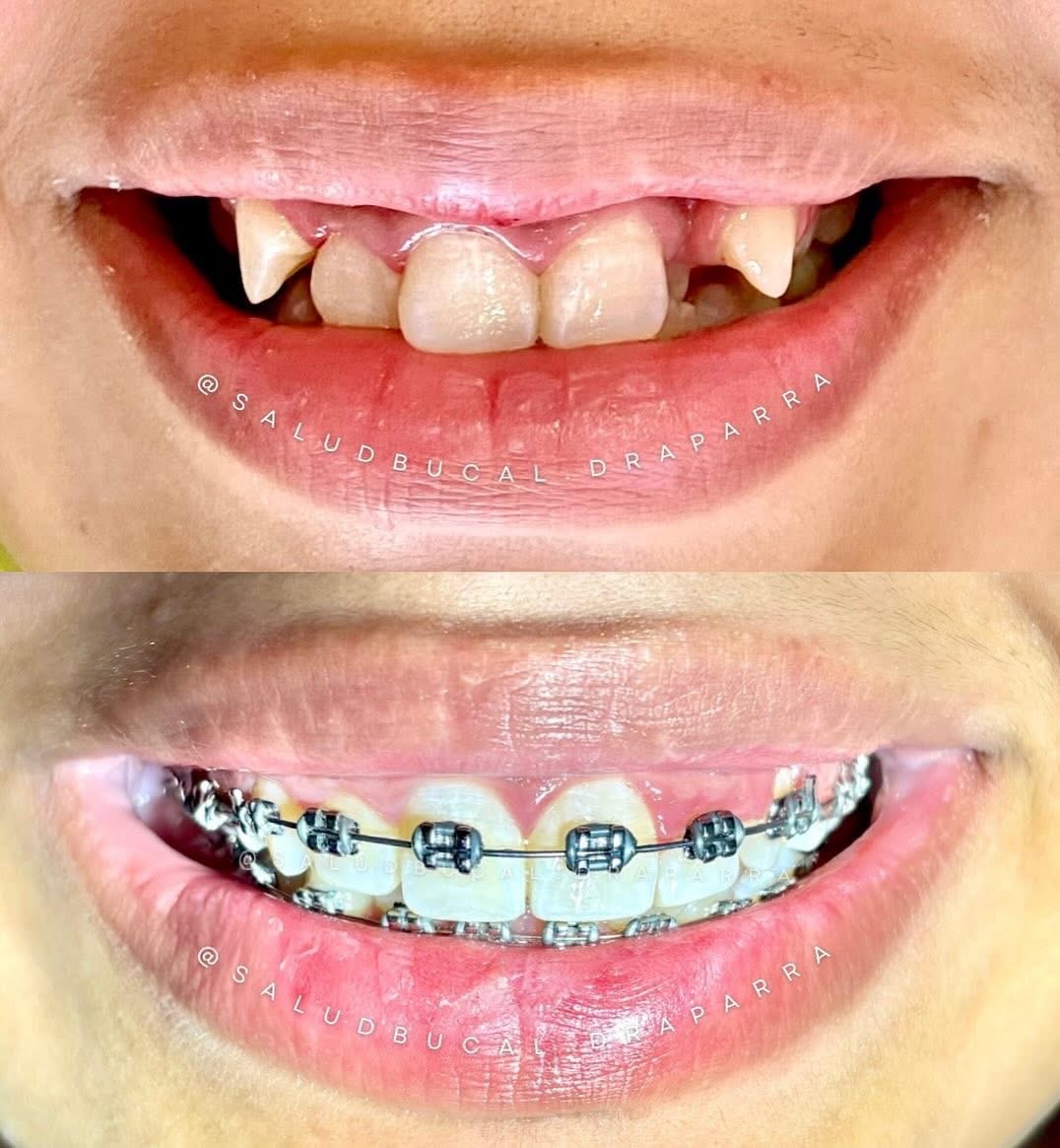 Antes y después de ortodoncia: dientes desalineados y el progreso con brackets
