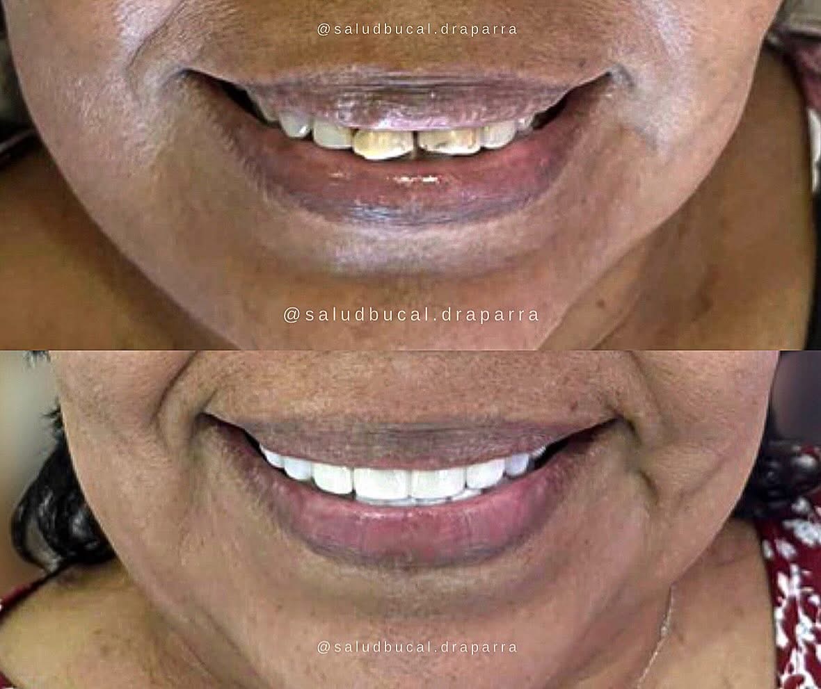 Antes y después de restauración con resina: dientes desgastados y manchados restaurados a un tono claro y parejo