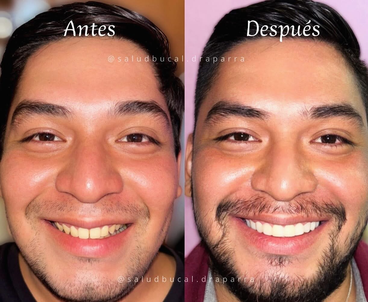 Antes y después de resinas estéticas: transformación completa de la sonrisa de un paciente
